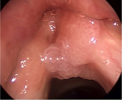 Recurrent Respiratory Papillomatosis (RRP)