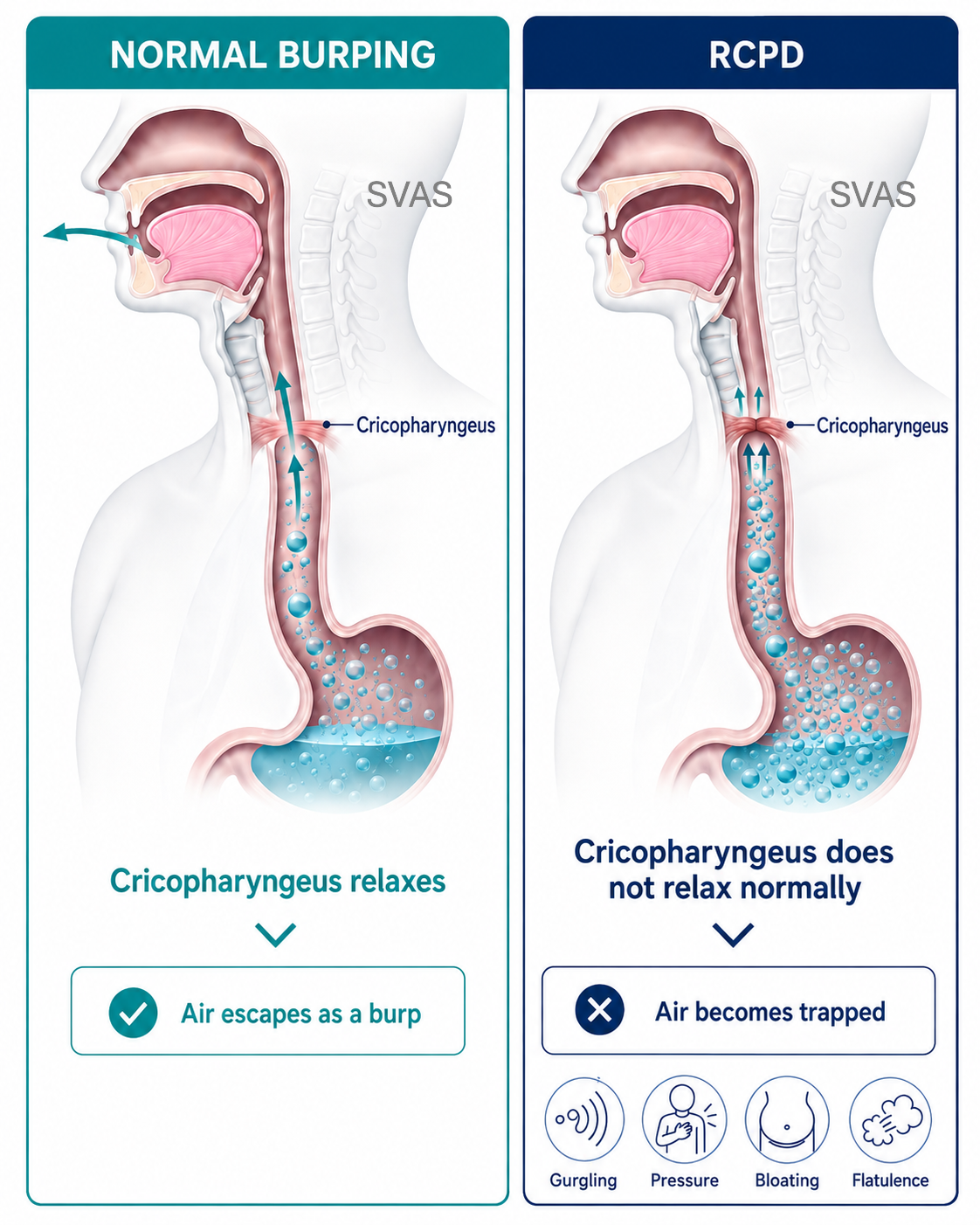 Diagram comparing normal burping with RCPD, showing cricopharyngeus relaxation allowing air to escape versus failure to relax causing trapped air, gurgling, pressure, bloating and flatulence.