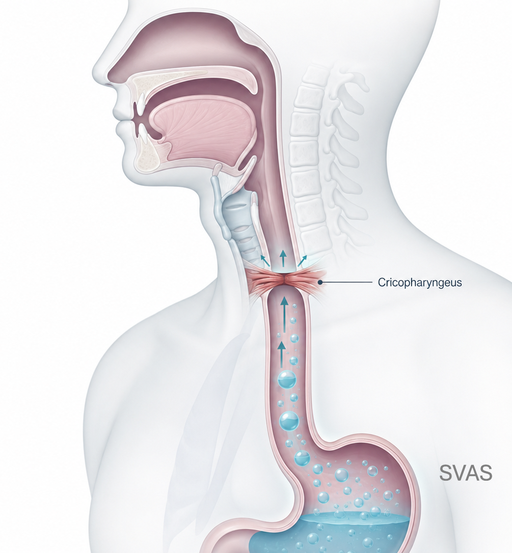 Illustration of cricopharyngeal dysfunction showing trapped air beneath the cricopharyngeus muscle