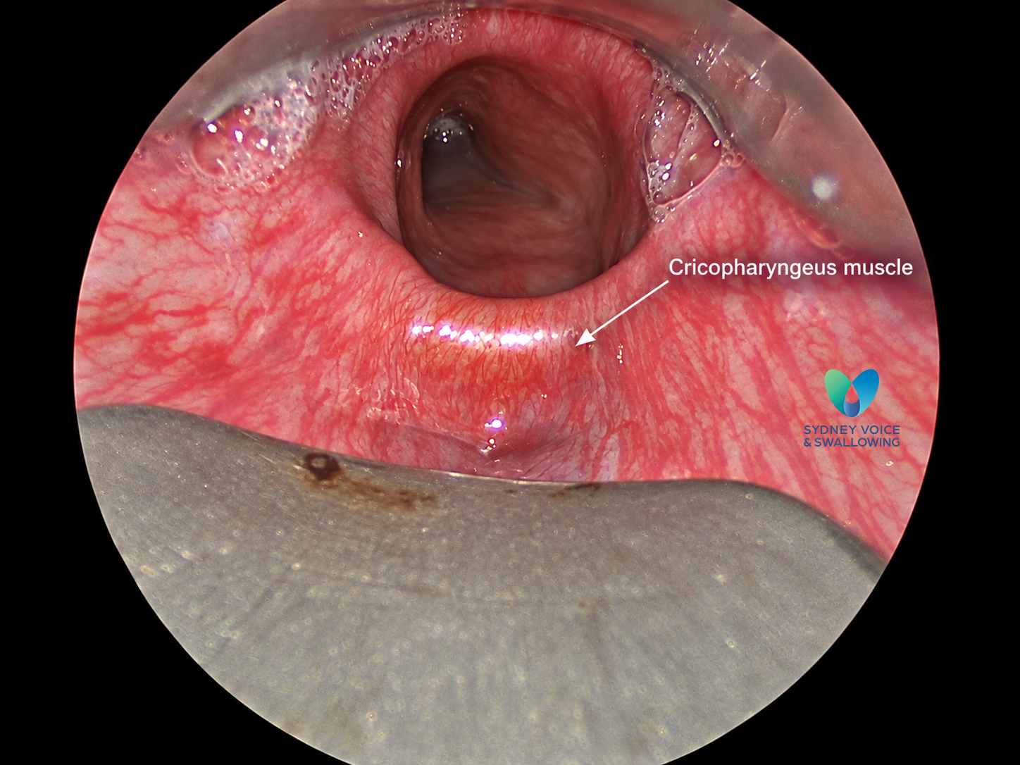 Intraoperative view of the cricopharyngeus muscle during RCPD treatment